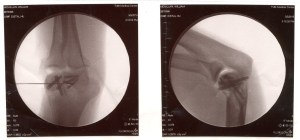 WillXRaysElbow